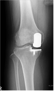 人工膝関節全置換術[TKA]のすべて より安全に・より確実に 改訂第2版+ 